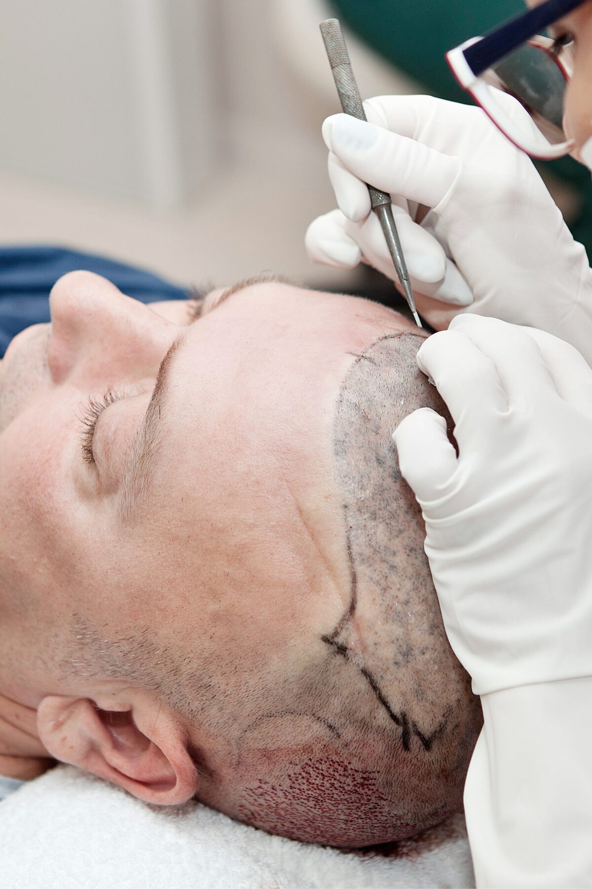 Social media management for hair transplant clinics by Dolly Social